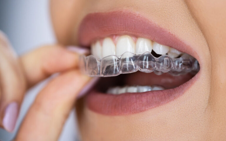 Straightening Your Smile: The Benefits of Invisible Aligners